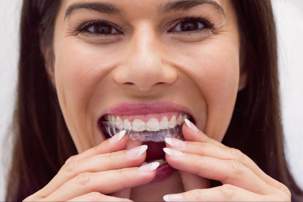 Everything you want to know about Crossbite