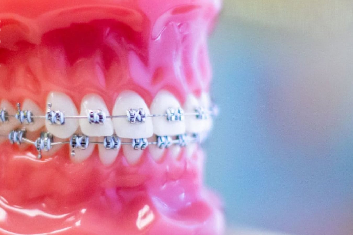 Exploring the Benefits of Teeth Straightening for Adults