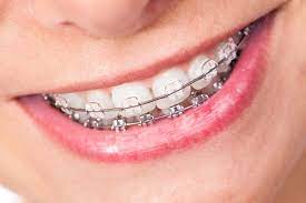 The Benefits of Clear Aligners for Straightening Teeth