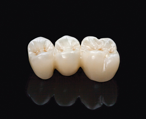 What To Expect During a Crown or Bridge Placement