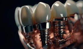 The Pros and Cons of Dental Implants vs. Other Tooth Replacement Options