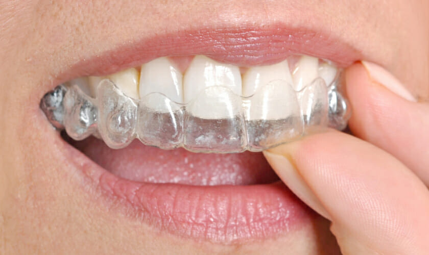 Benefits of Invisible Braces for Teens and Adults